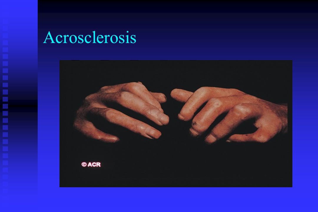 Acrosclerosis