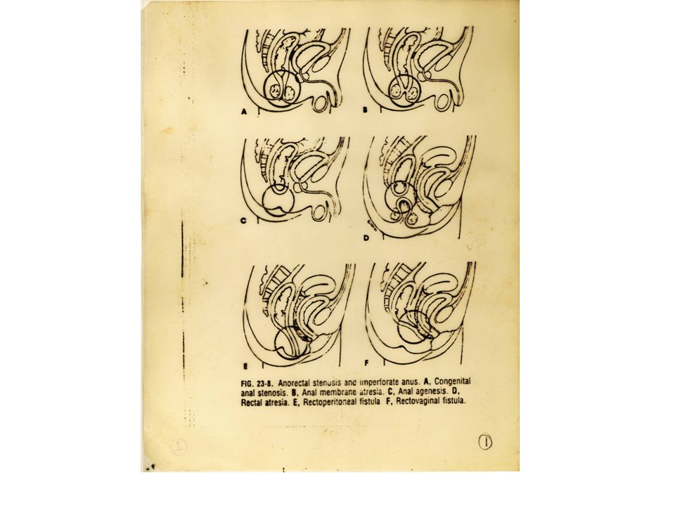 Congenital imperforate anus and recto-vaginal fistula same... There What necessary Congenital imperforate anus and recto-vaginal fistula really. join