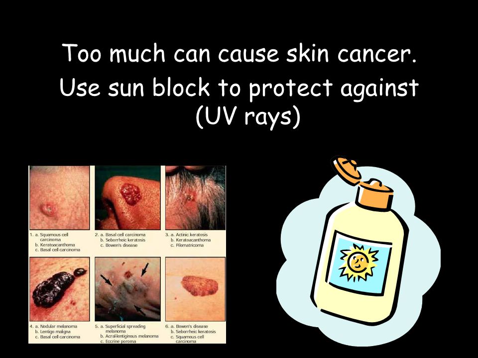 Too much can cause skin cancer. Use sun block to protect against (UV rays)