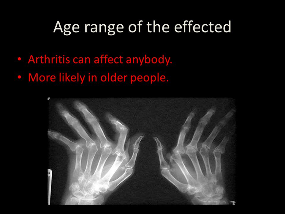 Age range of the effected Arthritis can affect anybody. More likely in older people.