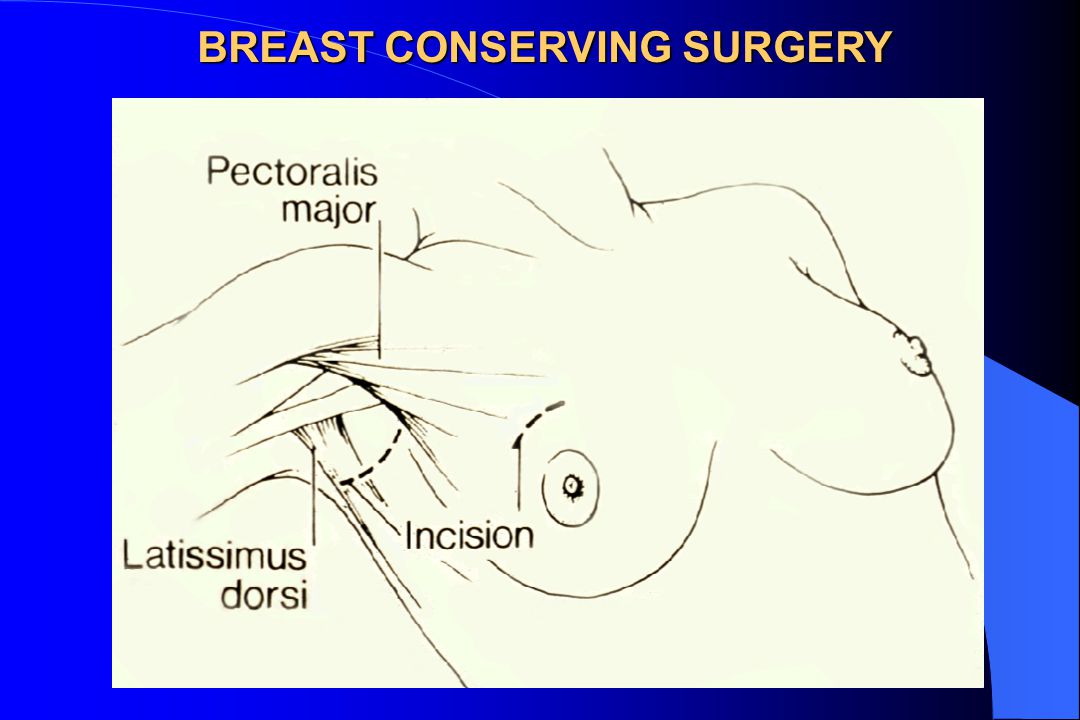 BREAST CONSERVING SURGERY
