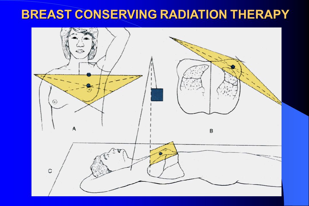 BREAST CONSERVING RADIATION THERAPY