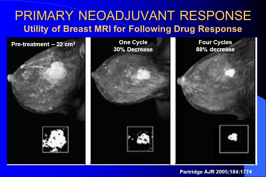 PRIMARY NEOADJUVANT RESPONSE PRIMARY NEOADJUVANT RESPONSE Utility of Breast MRI for Following Drug Response Partridge AJR 2005;184:1774 Pre-treatment – 22 cm 3 One Cycle 30% Decrease Four Cycles 88% decrease