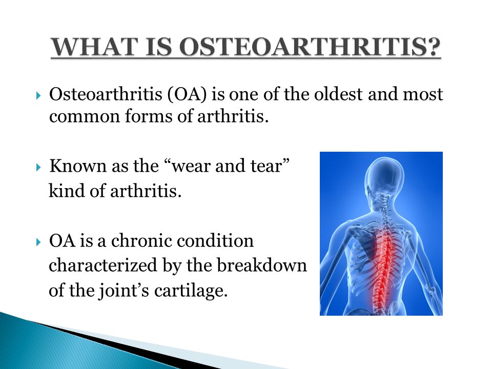 Osteoarthritis (OA) is one of the oldest and most common forms of arthritis.