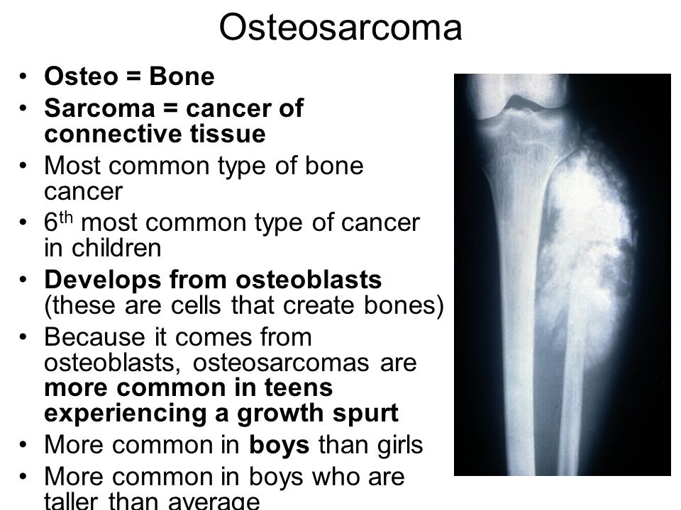 bone cancer syptoms in teens Homemade amature tgp pictures