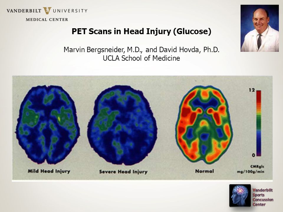 PET Scans in Head Injury (Glucose) Marvin Bergsneider, M.D., and David Hovda, Ph.D.