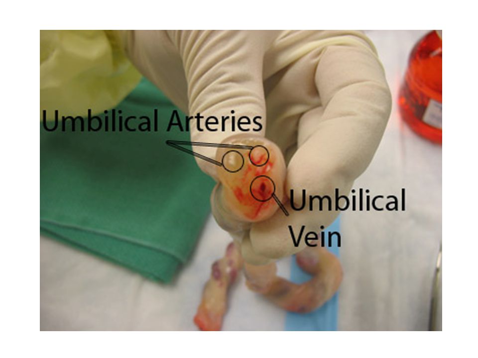 Fetal Circulation Umbilical vein Large Carries blood rich in nutrients and O2 to fetus