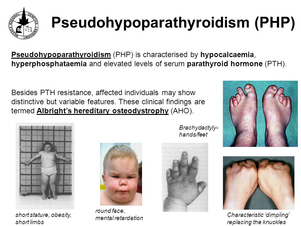 Development Of A Diagnostic Service For Pseudohypoparathyroidism Type 1b Jennifer Greatwood Ppt Download