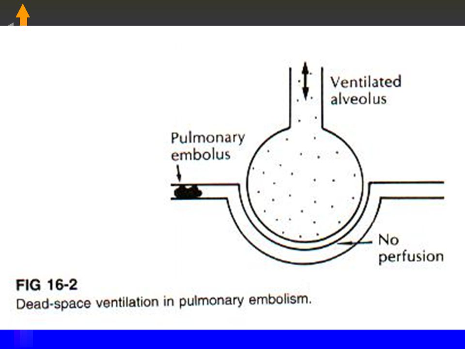 Pulmonary Embolism. Definition: Sudden lodgment of a blood clot in ...