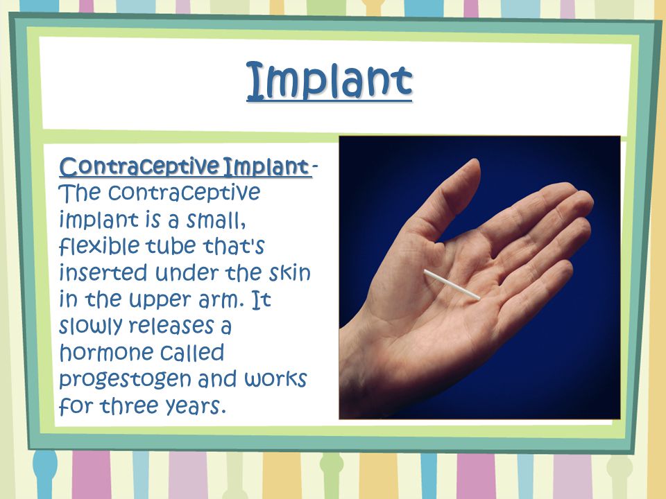 Implant Contraceptive Implant Contraceptive Implant - The contraceptive implant is a small, flexible tube that s inserted under the skin in the upper arm.