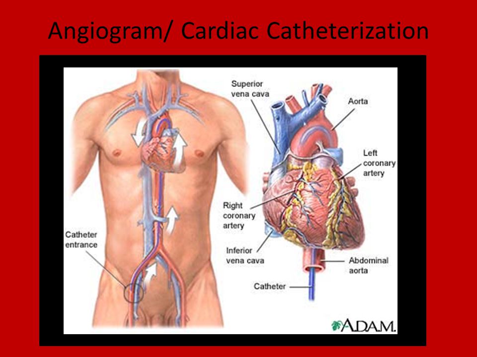 Angioplasty Preformed during an angiogram Small balloon placed inside artery to spread out plaque Restores proper blood flow A stent or wired tube may be placed and left in artery