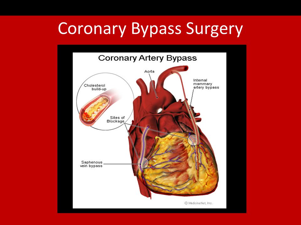 Coronary Bypass Surgery Approximately a week in the hospital Two to four weeks of home rest 4% of patients have serious complications Very painful