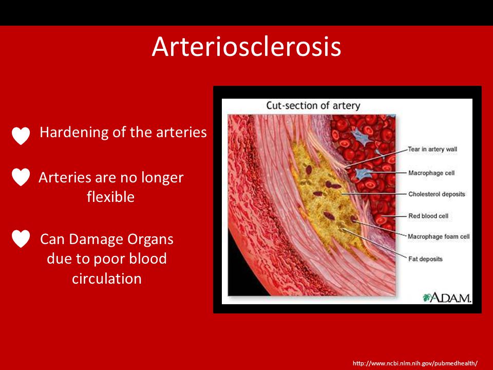 Conditions of Cardiovascular Disease Arteriosclerosis Atherosclerosis Angina Heart Attack Stroke