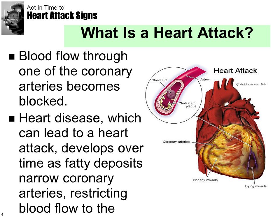 Ms Heart Attack Hot
