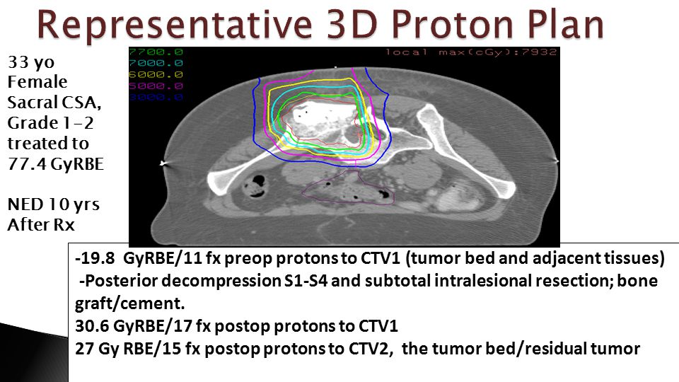 GyRBE/11 fx preop protons to CTV1 (tumor bed and adjacent tissues) -Posterior decompression S1-S4 and subtotal intralesional resection; bone graft/cement.