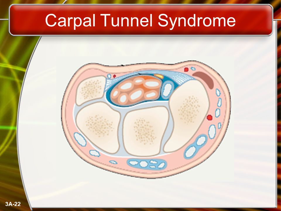 3A-22 Carpal Tunnel Syndrome