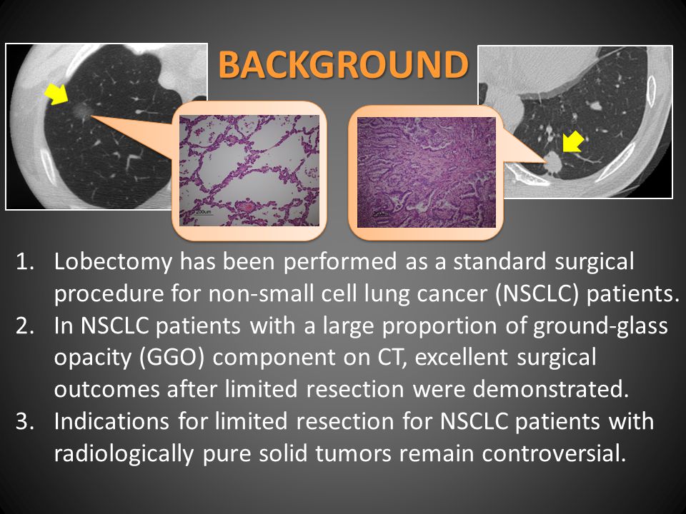 BACKGROUND 1.Lobectomy has been performed as a standard surgical procedure for non-small cell lung cancer (NSCLC) patients.