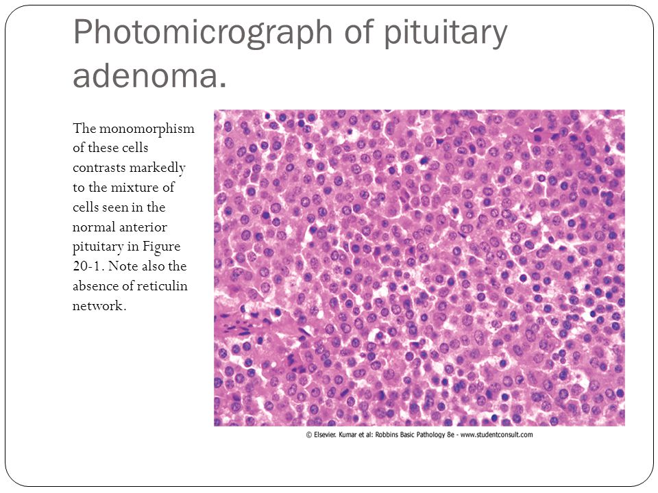 adenoma hypophysis pathology