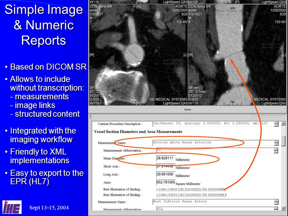 Sept 13-15, 2004IHE Interoperability Workshop 17 Simple Image & Numeric Reports Based on DICOM SRBased on DICOM SR Allows to include without transcription: - measurements - image links - structured contentAllows to include without transcription: - measurements - image links - structured content Integrated with the imaging workflowIntegrated with the imaging workflow Friendly to XML implementationsFriendly to XML implementations Easy to export to the EPR (HL7)Easy to export to the EPR (HL7)