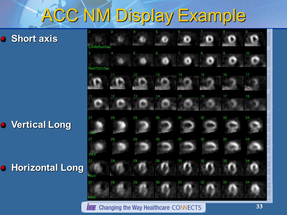 33 ACC NM Display Example Short axis Horizontal Long Vertical Long