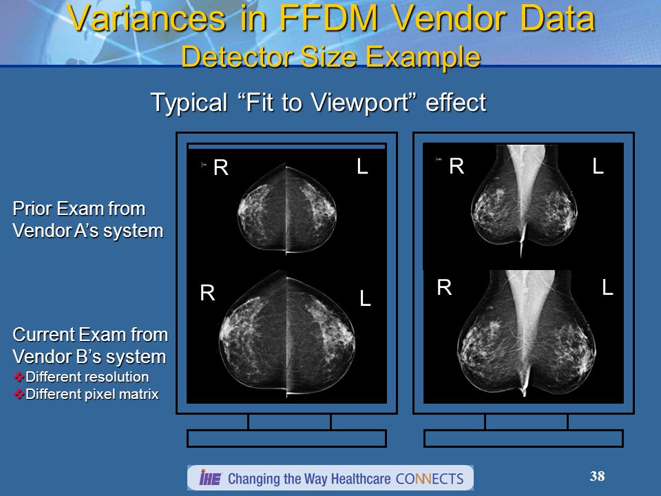 38 Variances in FFDM Vendor Data Detector Size Example R R L L R L Prior Exam from Vendor As system RL Typical Fit to Viewport effect Current Exam from Vendor Bs system Different resolution Different resolution Different pixel matrix Different pixel matrix