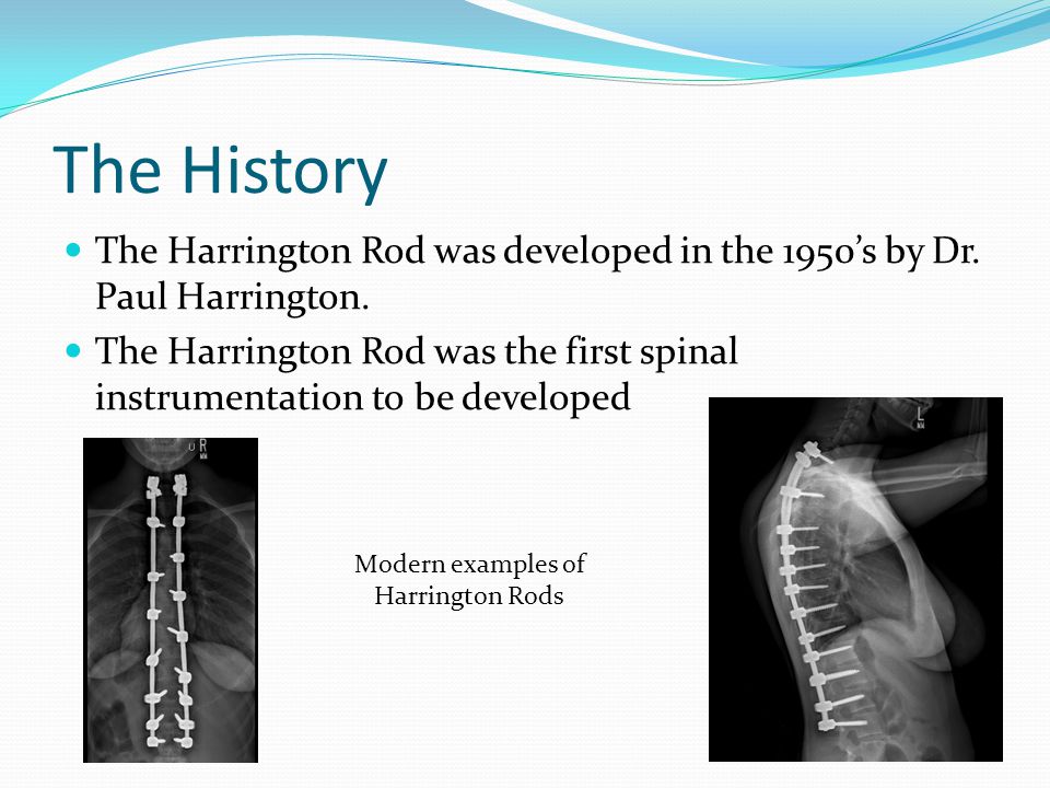 Presented by: Kelsey Foster. The History The Harrington Rod was developed  in the 1950's by Dr. Paul Harrington. The Harrington Rod was the first  spinal. - ppt download