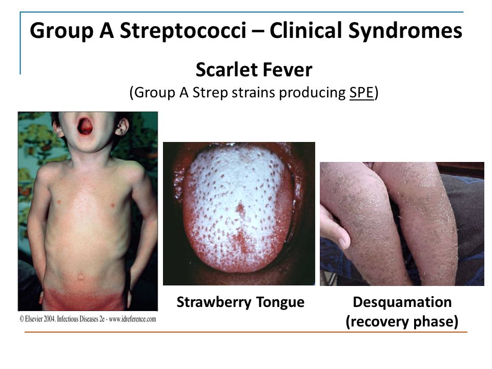 Group A Strep & Scarlet Fever - Readesmoor Medical Centre