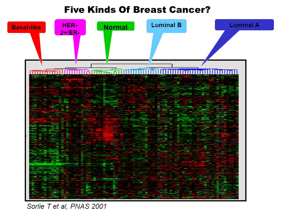 HER- 2+/ER- Luminal A Luminal B Normal Sorlie T et al, PNAS 2001 Basal-like Five Kinds Of Breast Cancer