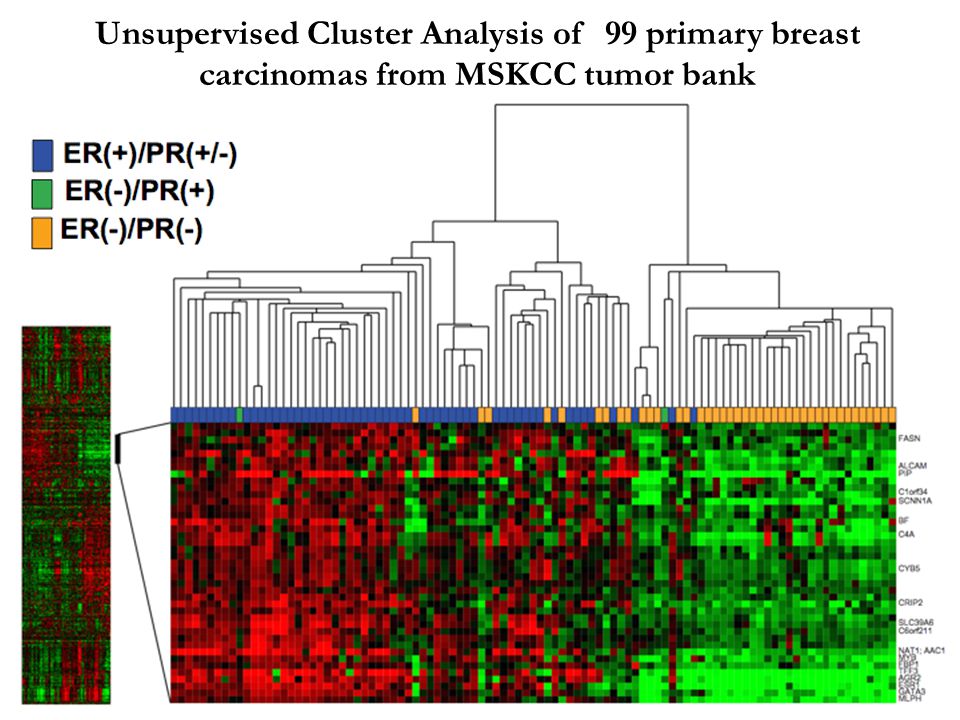 Unsupervised Cluster Analysis of 99 primary breast carcinomas from MSKCC tumor bank