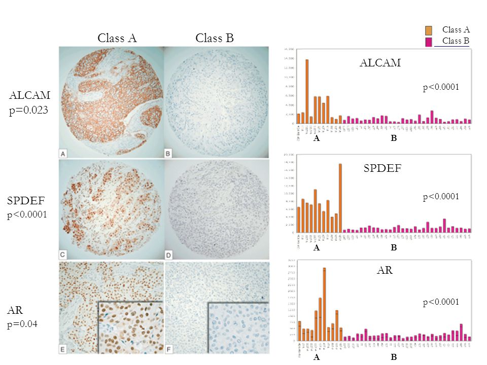 Class AClass B ALCAM p=0.023 SPDEF p< AR p=0.04 IHC for differentially expressed genes in ER(-) Class A p< ALCAM p< AR SPDEF p< AB B B A A Class A Class B