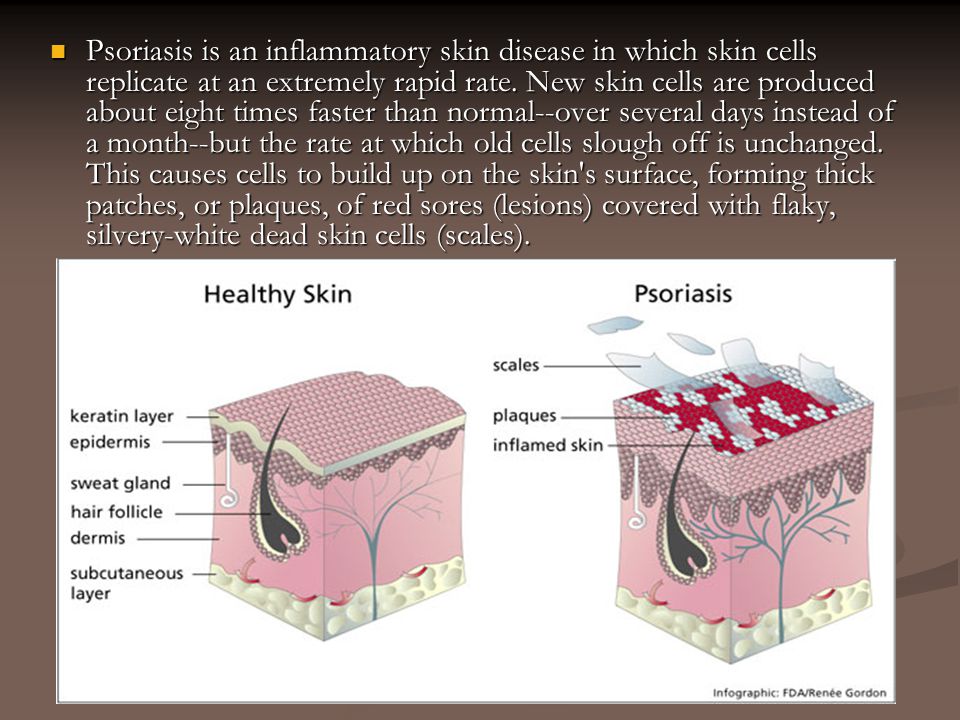 anatomy and physiology of psoriasis)