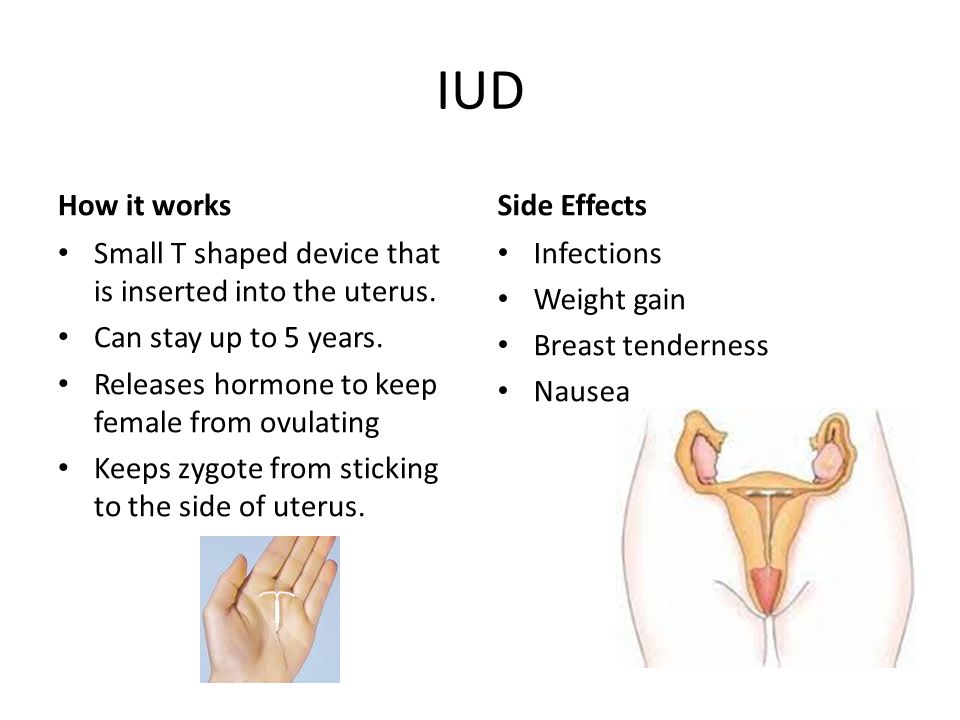 IUD How it works Small T shaped device that is inserted into the uterus.