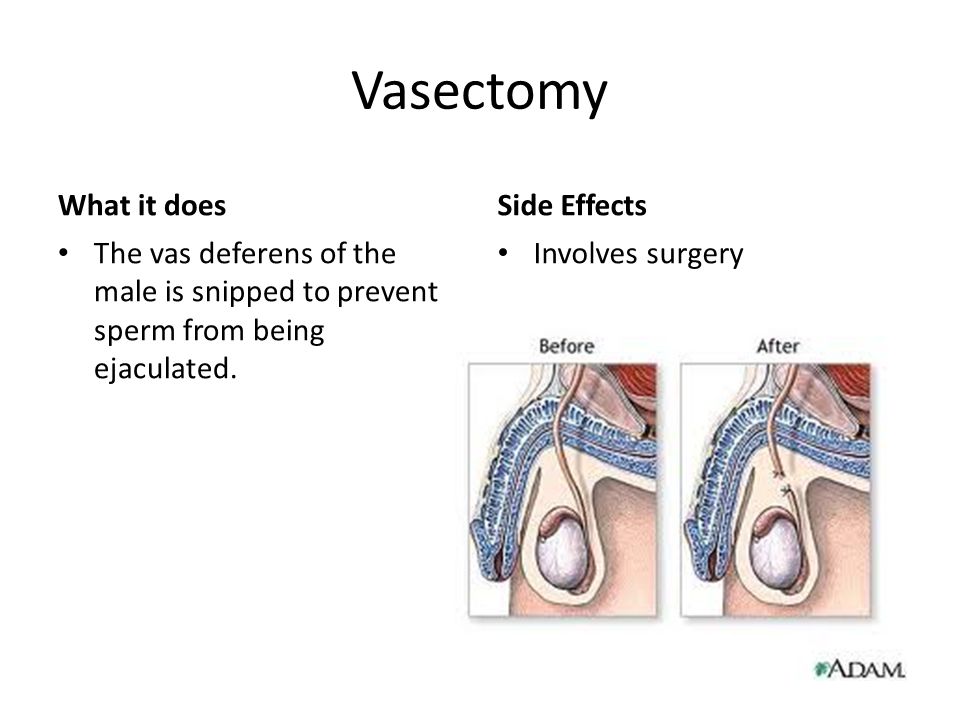 Vasectomy What it does The vas deferens of the male is snipped to prevent sperm from being ejaculated.