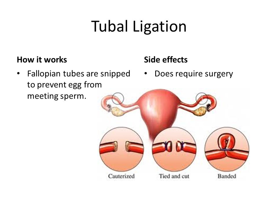 Tubal Ligation How it works Fallopian tubes are snipped to prevent egg from meeting sperm.