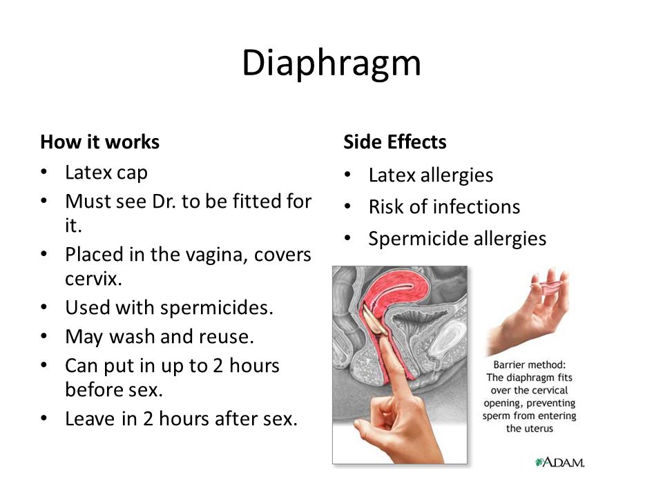 Diaphragm How it works Latex cap Must see Dr. to be fitted for it.
