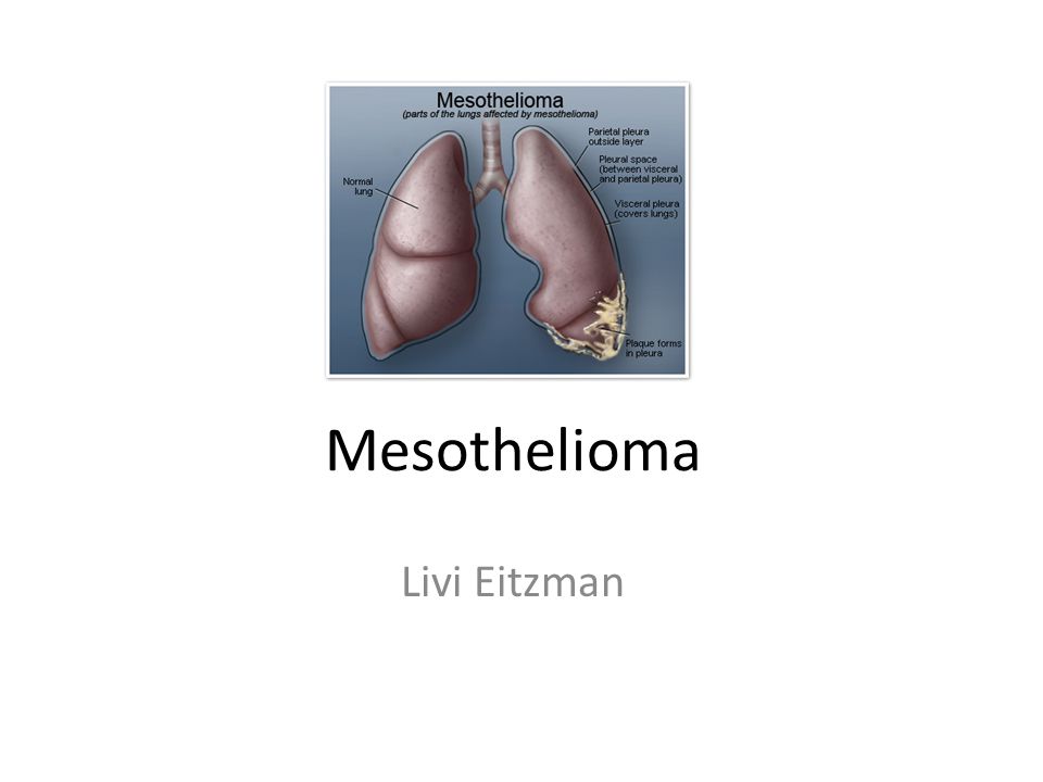 can mesothelioma cause bladder cancer