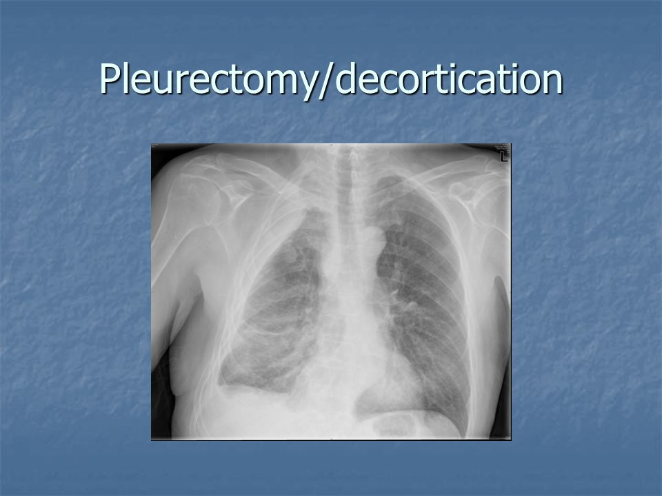 Pleurectomy/decortication