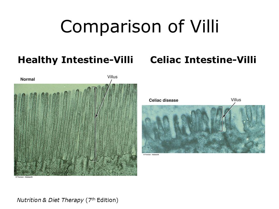 Comparison of Villi Healthy Intestine-VilliCeliac Intestine-Villi Nutrition & Diet Therapy (7 th Edition)