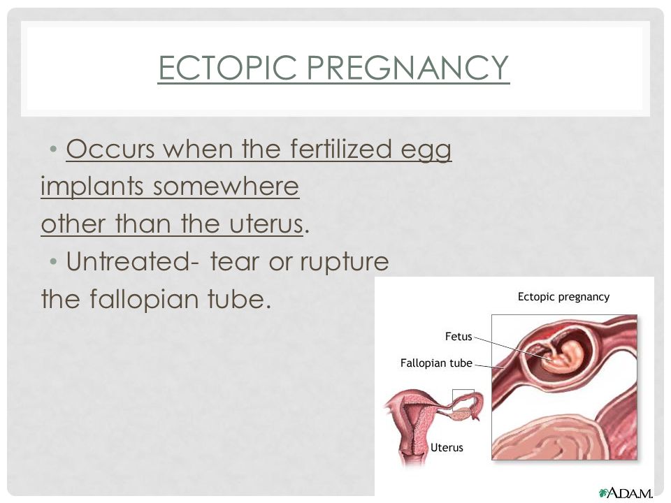 ECTOPIC PREGNANCY Occurs when the fertilized egg implants somewhere other than the uterus.