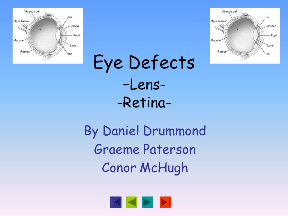 Eye Defects - Lens- -Retina- By Daniel Drummond Graeme Paterson Conor McHugh