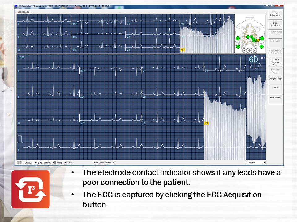 The electrode contact indicator shows if any leads have a poor connection to the patient.