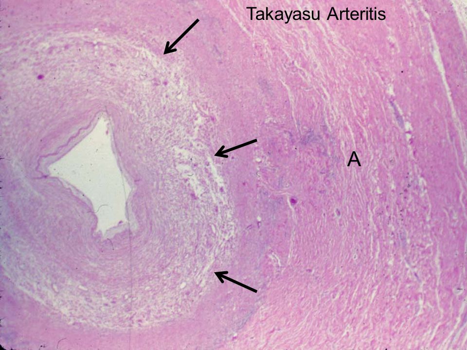 Image result for takayasu arteritis pathology