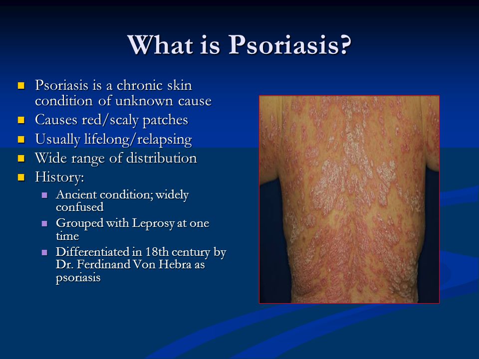 psoriasis presentation)