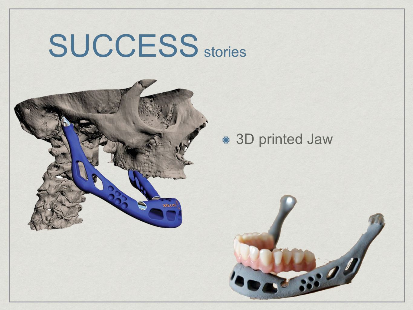 SUCCESS stories 3D printed Jaw