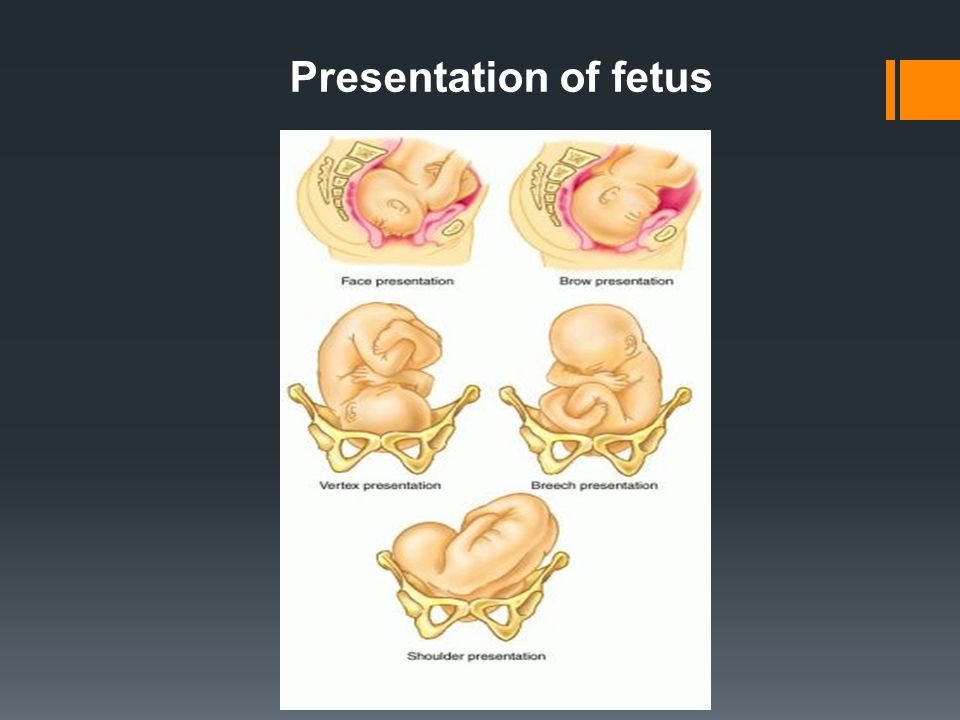 Presentation of fetus
