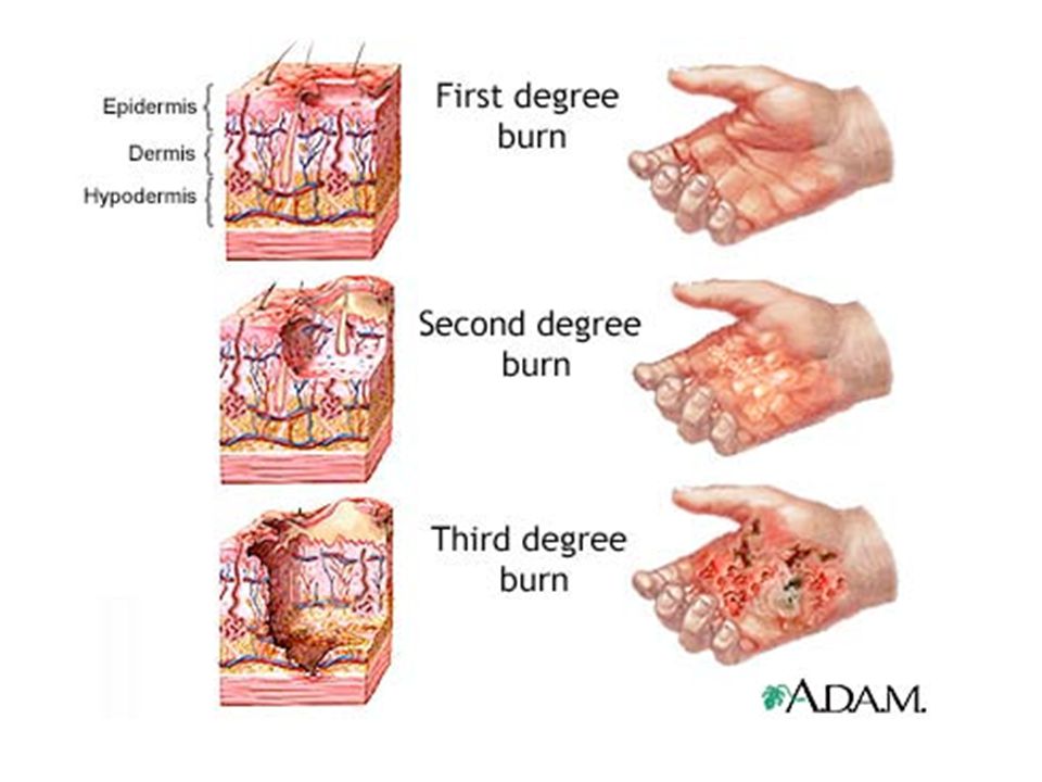 Burns of the Integument tissue damage inflicted by intense heat,  electrical, radiation, or certain chemicals all of which denature cell  proteins immediate. - ppt download