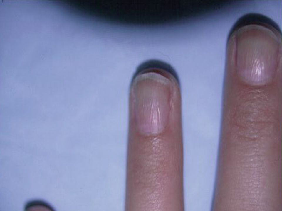 Nail Disorders Ppt Video Online 44 This Condition Is Usually Caused By Injury To The Matrix Excessive Use Of Cuticle Removers Harsh Cleaning Agents Nail Polish