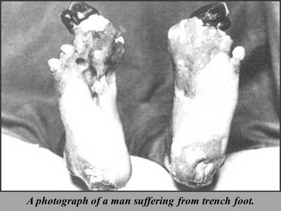 A photograph of a man suffering from trench foot.