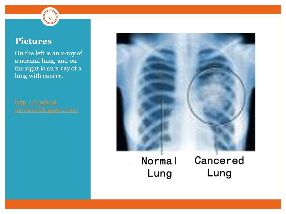 Pictures On the left is an x-ray of a normal lung, and on the right is an x-ray of a lung with cancer.