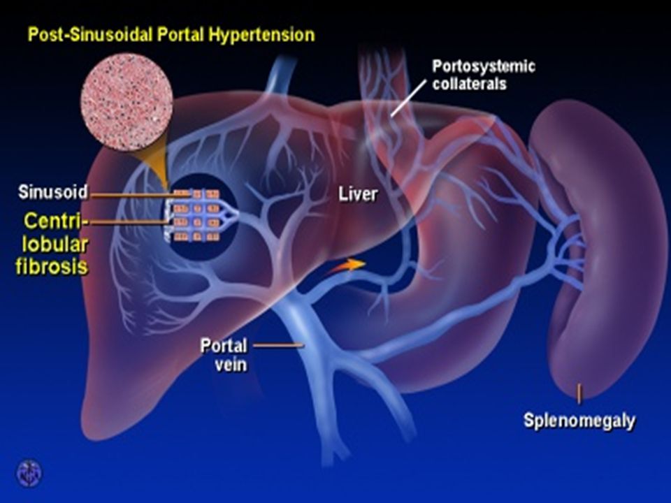 Печень портальный. Цирроз портальная гипертензия. Внутрипеченочная портальная гипертензия. Хронический гепатит портальная гипертензия.